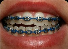 Dark Blue Braces, Power Chain Braces, Dental Braces Colors, Braces Colors Combinations, Braces Colors Ideas, Straighten Teeth, Braces Bands, Cute Braces Colors, Braces Cost