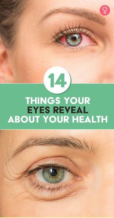 Forget the saying “Eyes are the windows to your soul.” They are actually indicators of your health! Long considered as one of the most attractive Blood Vessel In Eye, Eyes Health, What Is Health, Eye Pain, Vision Health, Health Plus, Types Of Eyes, Healthy Advice, Health Journal