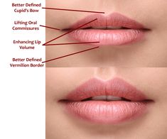 Juvederm Lips, Evening Eye Makeup, Natural Mouthwash, Minimal Makeup Look, Lip Filler, Aesthetic Medicine, Minimal Makeup, Lip Contouring