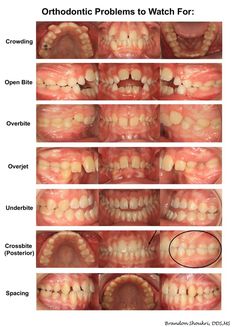 Braces care Dental Assistant Study Guide, Anatomy Dental, Dental Terminology, Dental Hygienist School, Dental Hygiene Student, Dental Videos, Kedokteran Gigi