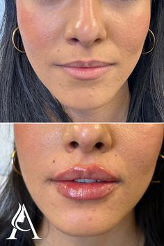 Lips before and after - we're OBSESSED with this first-time lip filler transformation!

Restylane Kysse lip filler in Philadelphia, PA. 

Book a consultation with our amazing injectors at Ari Blanc Medical Spa for your own lip makeover! Filler Transformation, Saggy Cheeks, Restylane Lips, Hyaluronic Acid Lips