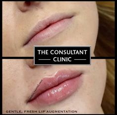 Lips Injections Shapes, Botox And Fillers Before After, Lip Fillers Before And After 1ml, Lip Injections Juvederm, Lip Filler Shape Ideas, Natural Lip Fillers, M Lips