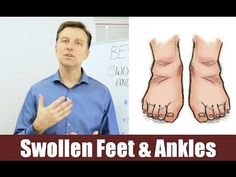 Foods for Fluid Retention in the Feet and Ankles Palmer College Of Chiropractic, Doctor Of Chiropractic, Precision Nutrition, Eric Berg, Dr Berg, Health Video, Fluid Retention, Body Condition