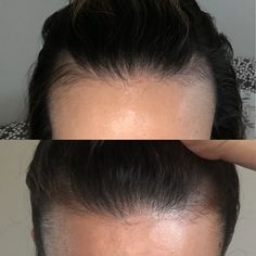 Thinning Hair Arabic Makeup, Thinning Hair, Hair Regrowth, Behind Ear Tattoo, Hair Growth, Surgery, Hair Care, Skin, Makeup