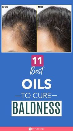 Best Oils To Cure Baldness: Some of the most painful sights are receding hairline, thinning of the hair and for some, just spot baldness. While many are running from pole to pillar for expensive hair care products and exorbitant hair spas, there are others that are trying all sorts of homemade remedies to battle impending baldness. Here we list out the top ten oils that can cure baldness. Read on to know more. #Remedies #HomeRemedies #NaturalRemedies #Baldness #HairCare Bald Spots Women Remedies, Hair Thinning Remedies Woman, Expensive Hair, Natural Hair Growth Remedies, Coffee Gif, Receding Hairline, Aging Hair, Hair Remedies For Growth, Hair Masks