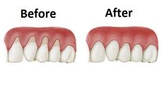 Gum Recession, Teeth Health, Receding Gums, Oil Pulling, Gum Health, Diy Health, Healthy Teeth, Natural Home Remedies, Health And Beauty Tips