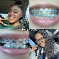 Power Chain Braces, Braces Food, Pretty Teeth