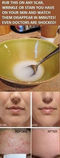 Remove Dark Spots, Beauty Remedies, Skin Remedies, Homemade Beauty Products, Health And Beauty Tips, Beauty Treatments, Face Care, Skin Treatments, Makeup Skin Care