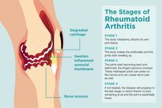 Rheumatoid Arthritis Stages and Progression Nursing Board, Sjogrens Syndrome, Muscle Fatigue