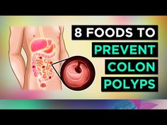 8 Foods To Prevent COLON POLYPS & BOWEL CANCER - YouTube Polyps Colon, Ryan Taylor, Holistic Doctor, Colon Health, Renal Diet, Healing Remedies, Natural Healing Remedies, Liver Health, Health Knowledge