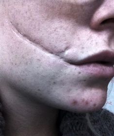 a woman with acne on her face