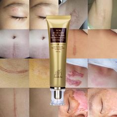 Say Goodbye to SCARS and STRETCH MARKS!! Grab your Discounted Scar Remover Serum while the LAUNCH DISCOUNT is on. Once we reach 200 unit sales, we will be increasing the price back up to $59.99. This Scar Remover Serum is applicable to people with acne or pimple scars, insect bite marks, stretch marks and surgical scars. It also helps to minimize and erase general skin defects. SUITABLE FOR A VARIETY OF WOUNDS AND MARKS! Features: Penetrates the skin cortex easily and softens the scar tissue. Pr Remove Acne Marks On Face, Acne Mark Removal, Acne Scar Removal Cream, Scar Remover, Scar Removal Cream, Pimple Scars, Skin Growths, Acne Scar, Acne Scar Removal