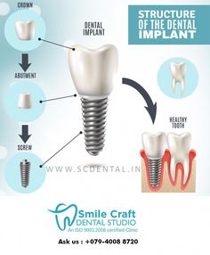 Dr.Nirali patel is the best dental Implants specialist, provides single implant, multipe implant,full mouth implant and other types of implants treatments near Ahmedabad, India. Smile Craft, Implants Dental, Hand Practice, Missing Tooth, Best Dental Implants, Dental Implant Surgery, Dental Implants Cost, Dentist Visit, Oral Surgeon