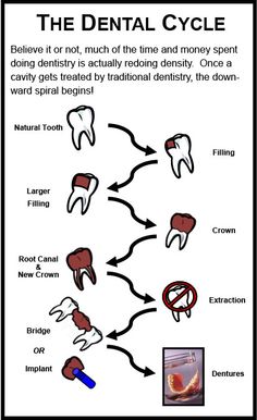 Good Teeth, Tooth Filling, Denture Implants, Dental Fun, Dental Facts