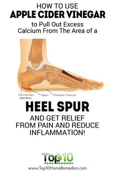 How to Use ACV to Pull Out Excess Calcium From The Area Of A Heel Spur And Get… Heel Spur, Top 10 Home Remedies, Natural Healing Remedies, Healthy Routine, Natural Therapy, Stretching Exercises, Epsom Salt, Natural Home Remedies, Cider Vinegar