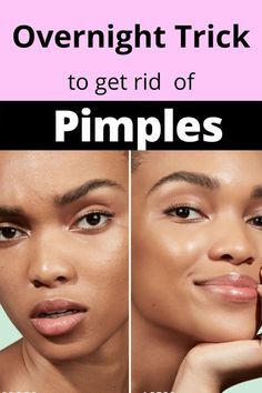 Pimple Remedies, Natural Remedies For Pimples, Pimples On Buttocks, Chin Acne