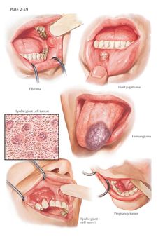 Oral Pathology, Dental Videos, Dental Anatomy, Dental Cavities