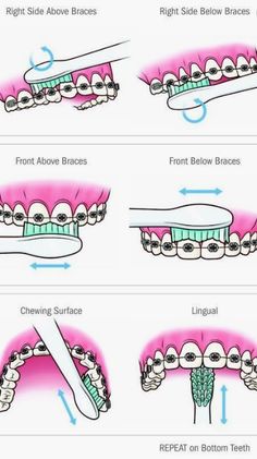 How To Brush Teeth With Braces, Straight Teeth Braces, Brushing With Braces, How To Brush With Braces, How To Take Care Of Braces Teeth, How To Brush Your Teeth With Braces, Foods You Cant Eat With Braces List, Cute Braces Colors Ideas, Brace Colors Ideas