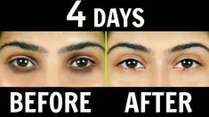 We all suffer from Dark Circles and there are so many reasons to have dark circles but you'll be surprised to know how easy it is to cure them so do checkout... Tips For Dark Circles, How To Do Facial, Dark Circles Makeup, Cucumber On Eyes, Diy Eye Cream, Under Eye Cream, Dark Eye Circles, Tan Removal