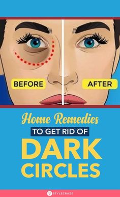 27 Best Home Remedies To Remove Dark Circles Under Eyes Permanently: There was a time when I loathed waking up in the morning. This was because I would have to look into the mirror and see those dark circles staring back at me. But when I got to know about some simple remedies that can help cure the condition, my joy knew no bounds. #Beauty #BeautyTips #Remedies #HomeRemedies #DarkCircles Remedies For Dark Circles, Dark Circle Remedies, Dark Eye Circles, Remove Dark Circles, Under Eyes, Dark Circles Under Eyes, Reduce Dark Circles, Dark Under Eye, Beauty Tips For Face