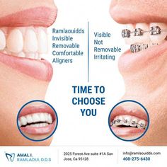 Our best dentists help straighten patients' teeth with Invisalign treatment in San Jose. Get teeth-straightening specialist treatment with clear braces. Dentist Social Media, Invisible Aligners, Clear Aligner, Teeth Alignment