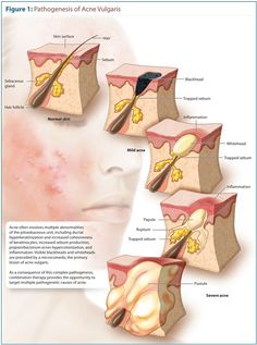 Acne Types, Different Types Of Acne, Hair Science, Fungal Acne, Skin Moles