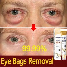 Product updates, new and old products are randomly shipped ������If you need a larger discount. You can click on the image below. Buy 5 get 5 free!!!�� Instant Eye Bag Removal Cream Collagen Removal Wrinkles Firming Skin Fade Fine Lines Anti-Aging Anti Puffiness Dark Circle Brighten Eye Care Korean ▶Effect:Reduces sign Eye Bag Removal, Eye Wrinkle Cream, Firming Skin, Cells Activity, Skin Fade, Remove Dark Circles, Face Wrinkles, Face Lines, Enlarged Pores