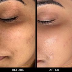 Bb Glow Before And After, Mesotherapy Before And After, Skin Before After, Skin Before And After, Best Facial Scrubs, Before And After Skincare, Bb Glow Facial, Hydrafacial Before And After