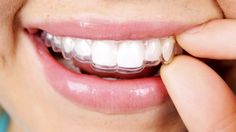 Discount Invisalign Getting Braces, Straight Teeth, Restorative Dentistry