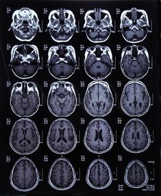 an mri scan shows multiple areas of the brain