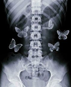 an x - ray image of a man's back with butterflies on it