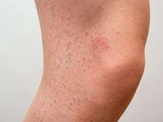 Want to wear skirts and dresses this summer but red bumps on your legs are stopping you? Don’t worry, this article has all the information you need to get rid. Red Spots On Legs, Heat Bumps, Bumps On Legs, Body Pimples, Leg Rash, Rashes Remedies, Redness Pimple, Red Rash, Natural Mouthwash