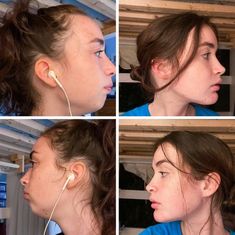 Corrective Jaw Surgery, Jaw Reduction Surgery, Face Plastic Surgery, Double Jaw Surgery, Chin Filler, Plastic Surgery Fail, Chin Implant, Rhinoplasty Nose Jobs, Face Fillers