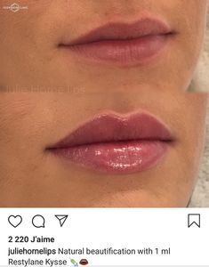 Lip Fillers Shapes, Lip Fillers Juvederm, Lip Job, Dermal Fillers Lips, Lips Fillers, Lips Shape, Lips Inspiration, Permanente Make-up, Face Fillers