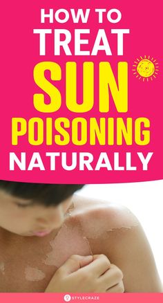 Burned Skin Remedies, Sun Poisoning Rash, Nails Remedies, Sunburn Blisters, Sun Poisoning, Remedies For Sunburn