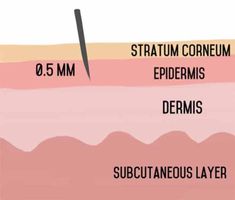 Nanoneedling Benefits, Microneedling Before And After, Microneedling Benefits, Benefits Of Microneedling, Aesthetics Business, Esthetician Life