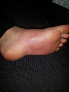 a person's foot with red spots on it