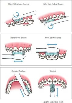 Dental Braces Colors, Braces Food, Cute Braces Colors, Braces Tips, Getting Braces, Cute Braces, Kedokteran Gigi, Brace Face