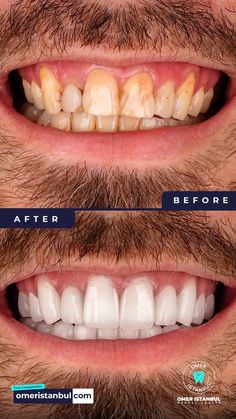 E-max Laminate Veneer Dental Treatment - Dental Before After - Omer Istanbul Dental Center Teeth Whitening At Home, Natural Teeth Whitening Remedies, Dental Anatomy, Teeth Whitening Remedies, Grills Teeth, Tooth Powder