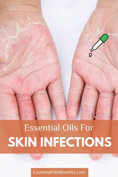 Discover how essential oils can help treat skin infections naturally! From tea tree oil to lavender, these powerful oils have antibacterial and soothing properties that promote healing. Learn about the best essential oils for various skin infections and how to use them in your skincare routine for a healthier, glowing complexion. #EssentialOils #NaturalHealing #SkinInfections #TeaTreeOil #LavenderOil #HolisticHealth #NaturalRemedies #HealthySkin #SkincareRoutine #Aromatherapy Essential Oils For Healing, Oils For Healing