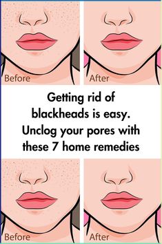 Getting rid of blackheads is easy. Unclog your pores with these 7 home remedies

Getting rid of blackheads is easy. Unclog your pores with these 7 home remedies Natural Remedies For Blackheads, How To Treat Blackheads On Nose, How To Stop Blackheads, How To Get Rid Of Blackheads On Nose Diy, Best Way To Get Rid Of Blackheads, Home Remedies For Blackheads, How To Extract Blackheads, Pores On Face How To Get Rid Of At Home, How To Get Rid Of Blackheads At Home