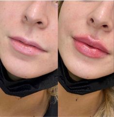 Simple Lip Injections, Natural Looking Filled Lips, Lip Filler M Shaped Lips, Lip Filler Contour, Lip Filler Before And After Side Profile, Small Lip Injections Before And After, Lip Injections Small Lips, Face Symmetry Fillers, Pouty Lips Injections