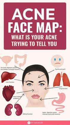 Acne face map is an ancient concept practiced widely in Chinese and Ayurvedic medicines. Want to know more? Check out this post to read about the acne face map. Acne Map, Acne Face Map, Face Map, Face Mapping Acne, Blind Pimple, Forehead Acne, Pimples Under The Skin, Bad Acne, Prevent Pimples