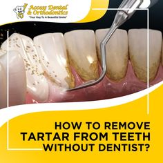 Read How to Remove Plaque & Tartar From Teeth without Dentist at home with our easy to follow guide on Plaque & Tartar removal without Dentist. How To Get Plaque Off Teeth, Diy Plaque Remover Teeth, How To Remove Plaque From Teeth, How To Clean Plaque From Teeth, How To Get Rid Of Tartar Build Up, Tartar Removal From Teeth At Home, How To Remove Plaque From Teeth At Home Natural Remedies, Removing Plaque From Teeth At Home, How To Remove Tartar From Teeth At Home