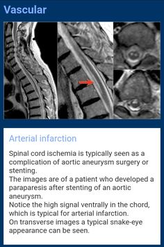 an mri scan with the words,'artificial infraction'and two images