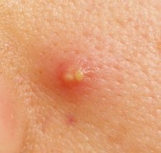 A boil is a common skin condition, formed under the skin typically when hair follicles or oil glands get infected by some bacteria. Initially, the area becomes red followed by the development of a lump filled with pus. It commonly occurs in the areas of face, neck, armpits, buttocks, shoulders and thighs. Boils On Skin, How To Treat Boils, Laser Stretch Mark Removal, Skin Boil, Home Remedy For Boils, Best Blackhead Remover, Pimple Solution, Clean Blackheads, Acne Help