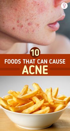 The relationship between food and acne is controversial. There are contradicting studies in this regard, with some even claiming to have zeroed in on foods that cause acne.