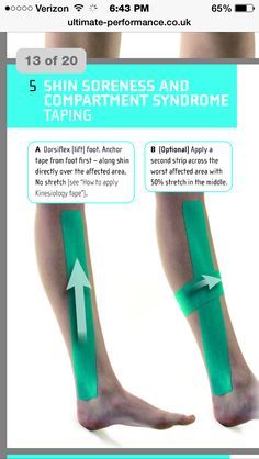 Kinesio tape for compartment syndrome Taping For Shin Splints, Knock Knees, How To Help Nausea, Kinesio Taping, Kinesiology Taping