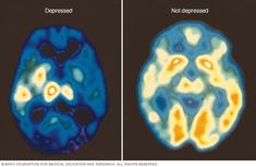 Brain Scans, Healthy Bedtime Snacks, Pet Scan, Brain Scan, Healthy Brain, Brain Activities, Nervous System, Change Your Life, Anatomy