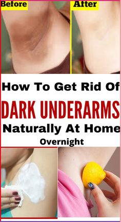 Looking for how to get rid dark underarm naturally at home.Here is 10 natural home remedies and tips that will lighten your underarms. #Homeremedies #underarms #DIY #natural #getrid Whiten Underarms Fast, Rid Of Dark Underarms, How To Whiten Underarms, Dark Armpits, Lifting Facial, Dark Underarms, Magnesium Deficiency, Unwanted Hair Removal, Homemade Remedies